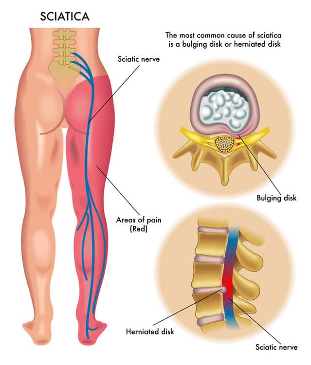 Lumbar Discal Hernia - Causes and treatment - Neurocirugía Barcelona