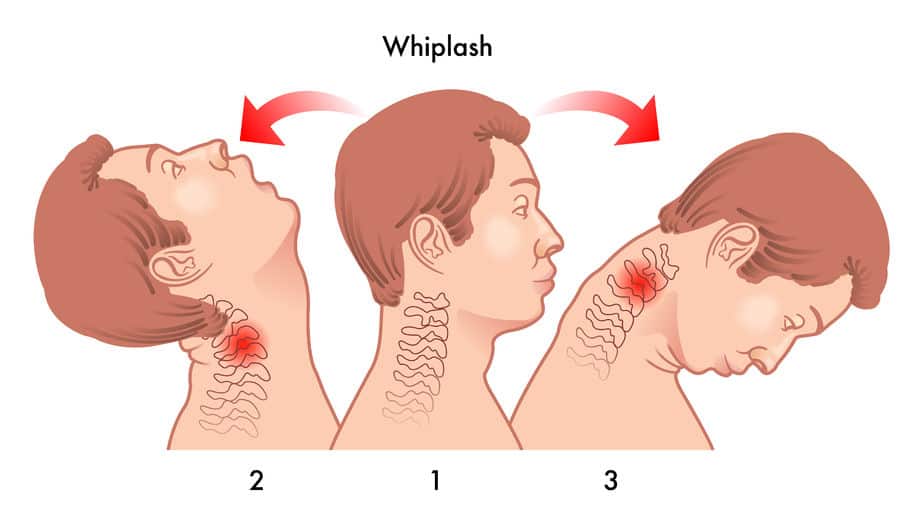58188286 - whiplash injury